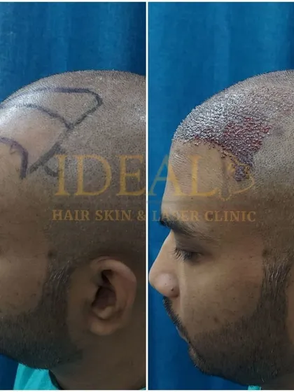 A side-profile comparison of a patient before and after the implantation stage of the FUE transplant, showing the newly created hairline.