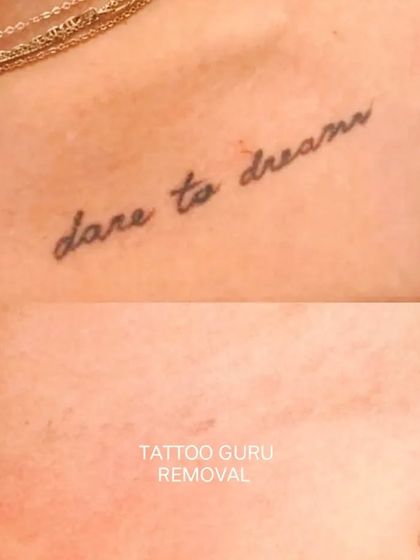 A delicate script tattoo, 'dare to dream', removed from the collarbone area. The goal is always to restore the skin to its natural appearance as much as possible.