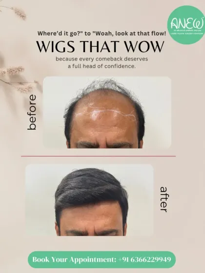 For those seeking an immediate and dramatic change without surgery, I offer custom hair systems. This before and after showcases a complete transformation, providing a full head of hair that blends seamlessly and restores confidence instantly.