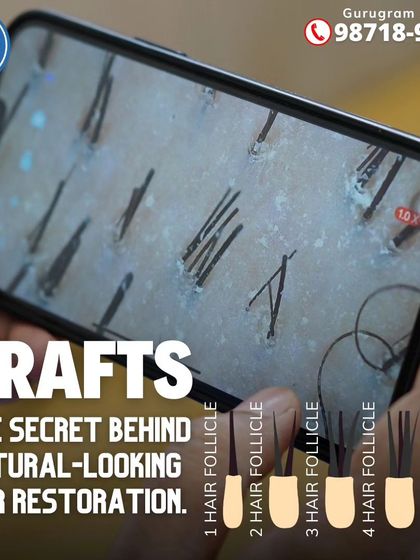 What is a hair graft? This image explains it perfectly. A single graft can contain 1 to 5 hair follicles. Understanding this is key to understanding how we achieve natural-looking density.