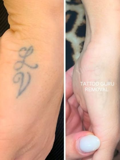 A clear before and after of initials removed from the side of the hand. This area has thin skin, but with careful work, we can achieve great results with minimal scarring.