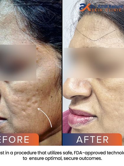 A closer look at the improvement in skin texture and the softening of deep rolling scars. This result was achieved using safe, FDA-approved technology.