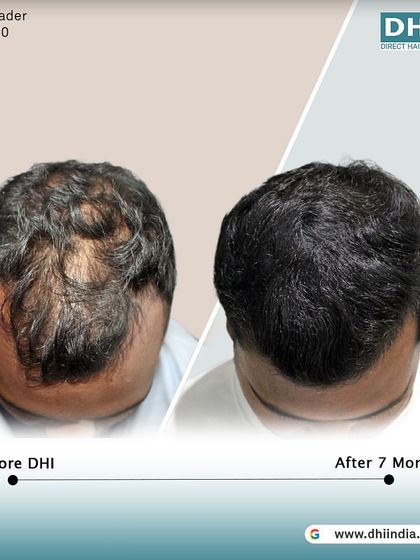 A top-down view of the same client's 7-month progress. With 5,032 hairs implanted, the coverage and density are excellent, demonstrating a successful transformation for this young patient.