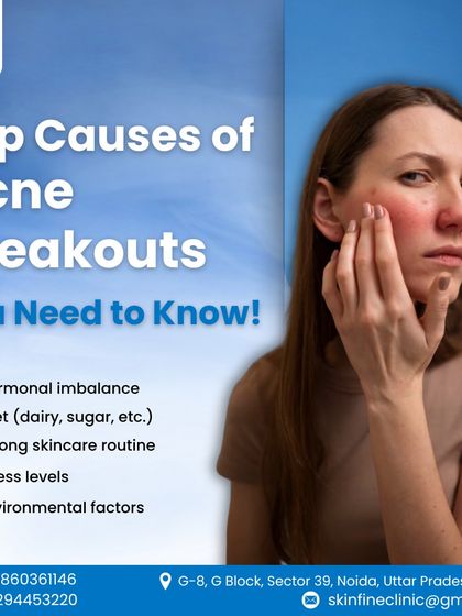 This graphic outlines the primary causes of acne breakouts that you need to know. I address these factors, including diet, stress, and environmental triggers, as part of a holistic treatment approach.