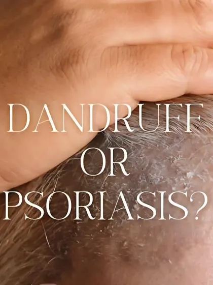 It's important to distinguish between dandruff and psoriasis, as they require different treatments. This graphic explains the key differences between the white, greasy flakes of dandruff and the thick, silvery scales of psoriasis.