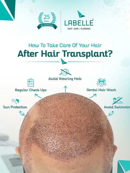 A successful hair transplant is a partnership. We guide you through every step, including post-procedure care. This guide shows the crucial steps like sun protection, gentle washing, and regular check-ups to ensure your new hair grows strong and healthy.
