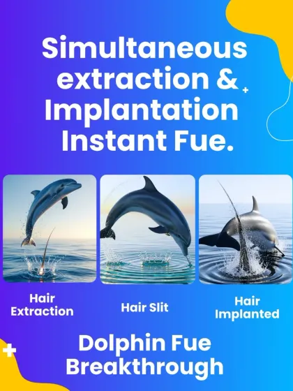 This is our Instant FUE technique, which I call the 'Dolphin FUE'. Like a dolphin jumping out of and back into the water, we extract and implant the hair graft almost simultaneously. This minimizes shock to the hair and leads to much better survival and growth.
