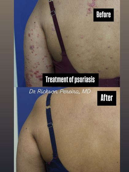 Here is a clear example of how targeted biologic therapy can resolve psoriasis lesions on the upper body. These modern treatments are convenient and have a strong safety profile, making them suitable for long-term use.