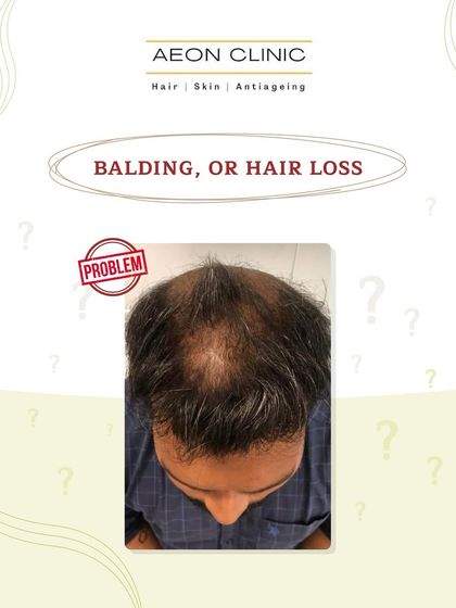 The problem: balding or hair loss. This is the starting point for many of our patients' journeys.