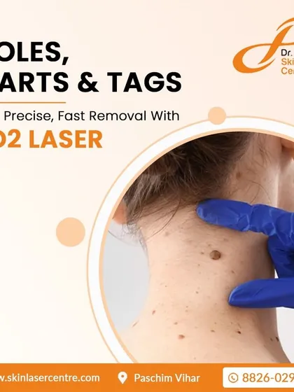 This graphic highlights my use of the CO2 laser for the safe, precise, and fast removal of moles, warts, and tags. It is a cornerstone of my practice for achieving blemish-free skin.