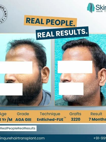 Another angle of the 28-year-old patient's 7-month result. This view highlights the seamless integration of the transplanted hair with his existing hair, showcasing the precision of the EnRiched-FUE technique.