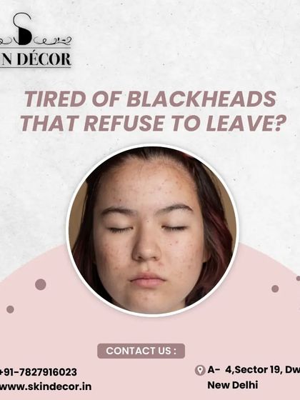 Tired of stubborn blackheads that just won't go away? I use professional methods like ultrasonic extractions to safely and effectively clear clogged pores without causing the hyperpigmentation that can result from trying to remove them at home.