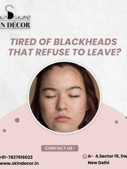Tired of stubborn blackheads that just won't go away? I use professional methods like ultrasonic extractions to safely and effectively clear clogged pores without causing the hyperpigmentation that can result from trying to remove them at home.