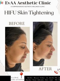 Skin Tightening & Non-Surgical Lifts