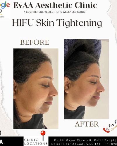 Skin Tightening & Non-Surgical Lifts