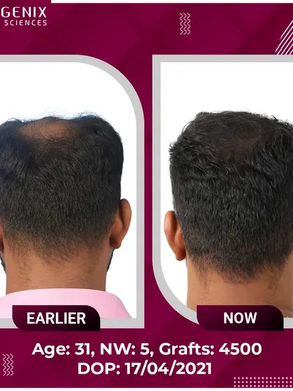 This 31-year-old patient's journey from Grade 5 hair loss to happiness with 4500 grafts.