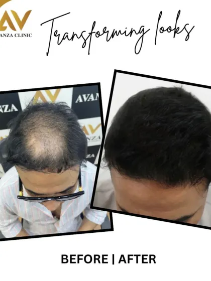 A close-up view of a restored hairline. The 'after' shot shows dense, natural-looking hair that completely covers the previously balding area.