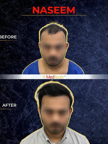 This is a clear before-and-after of Naseem's hair restoration. The top image shows the extent of his hair loss in the frontal and central zones before the procedure.
