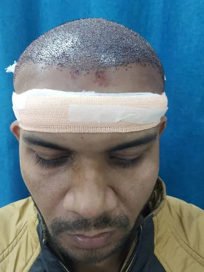A frontal view of a patient right after the FUE surgery, with a protective bandage. This shows the immediate post-operative stage of the hair restoration journey.
