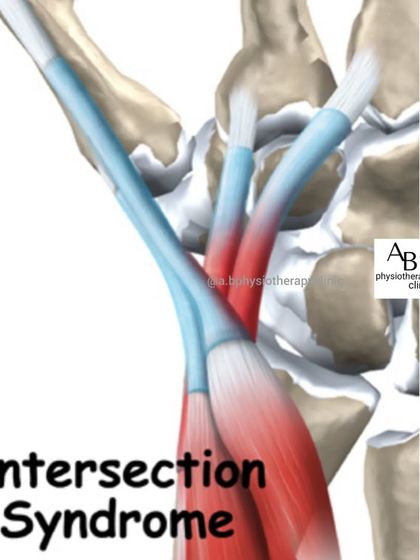Intersection Syndrome is a type of tendonitis in the wrist, often confused with De Quervain's. It's common in athletes like rowers and weightlifters who perform repetitive wrist movements.