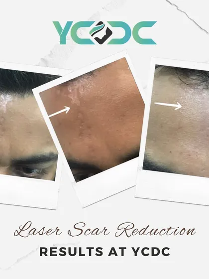 Scars don't have to be permanent. This image shows the significant reduction of a facial scar over three months using our advanced Luminis Resurfx laser technology, which promotes collagen production for smoother skin.