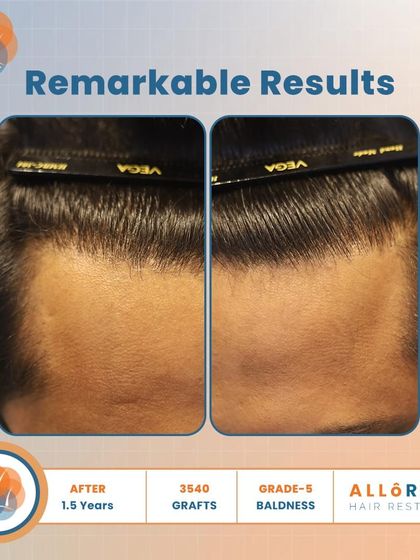 Remarkable results after 1.5 years for a Grade 5 baldness case. Using 3540 grafts, we achieved a dense and natural-looking outcome, as shown in these detailed before-and-after shots.
