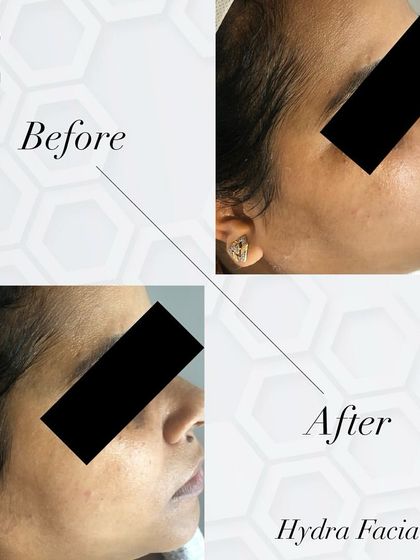 See the transformation. This before and after shows a visible reduction in pigmentation and a brighter, more even skin tone post-HydraFacial.