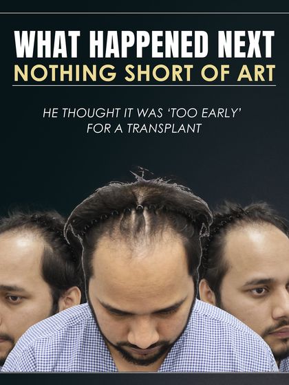 This patient thought his hairline was gone forever. This image shows his Grade 3 baldness before we began the restoration process.