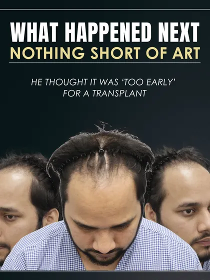 This patient thought his hairline was gone forever. This image shows his Grade 3 baldness before we began the restoration process.