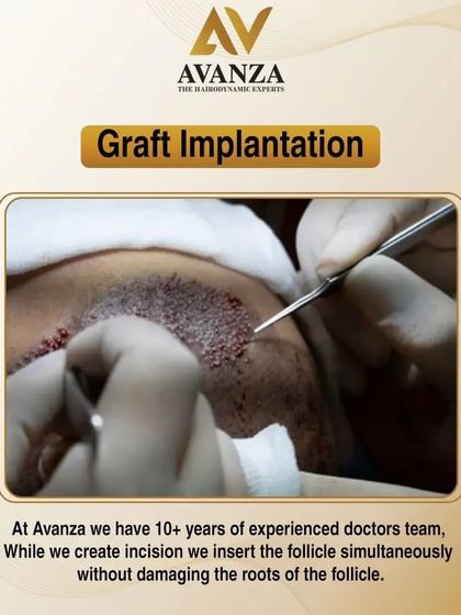 This image shows the graft implantation stage. Our experienced team creates the incision and inserts the follicle simultaneously, a key part of our technique that protects the root and ensures high graft survival.