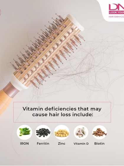 This image highlights key vitamins and minerals whose deficiencies can lead to hair loss. Iron, Ferritin, Zinc, Vitamin D, and Biotin are all essential for maintaining a healthy hair growth cycle.