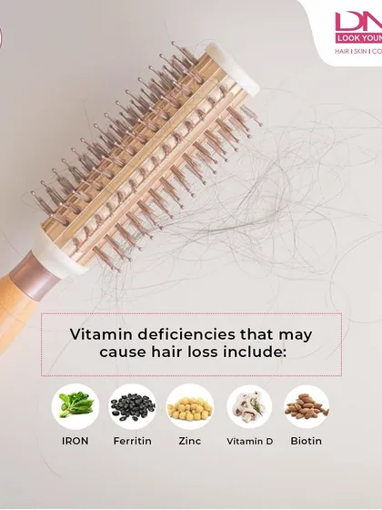This image highlights key vitamins and minerals whose deficiencies can lead to hair loss. Iron, Ferritin, Zinc, Vitamin D, and Biotin are all essential for maintaining a healthy hair growth cycle.