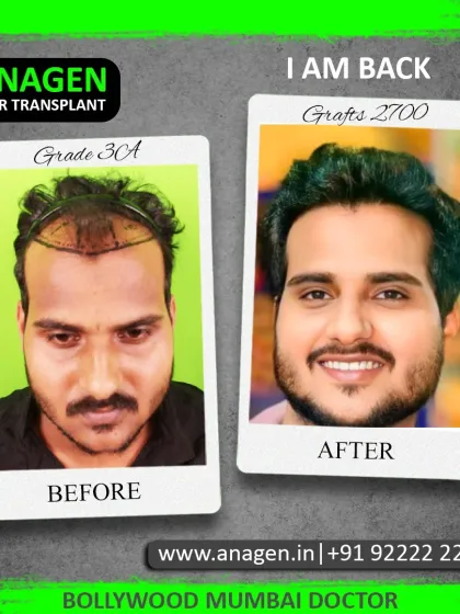 "I am back." A powerful statement from a happy patient who underwent a 2700 graft transplant for Grade 3A baldness. His smile shows his restored confidence.