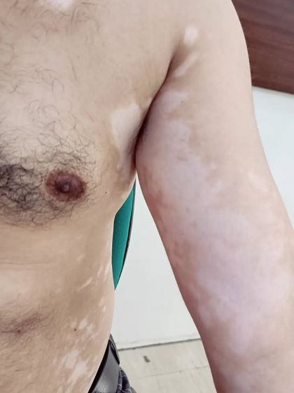 Here you can see Vitiligo patches on the arm and chest area. My treatment plan is designed to halt the progression and begin the process of repigmentation.