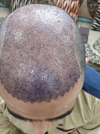 A close-up of the scalp immediately after graft implantation. Notice the precision and density we achieve.