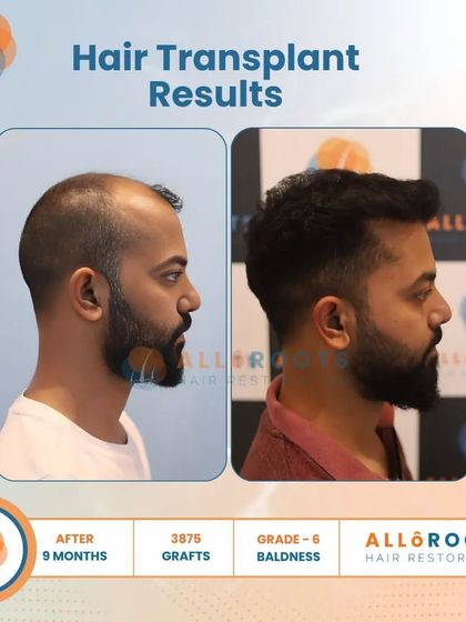 This 9-month result for a Grade 6 baldness case, achieved with 3875 grafts, is a testament to what is possible even in advanced stages of hair loss. The transformation is comprehensive and natural.