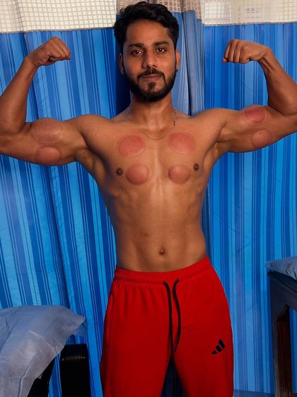 Client Saifaan Khan flexing after his cupping session.
