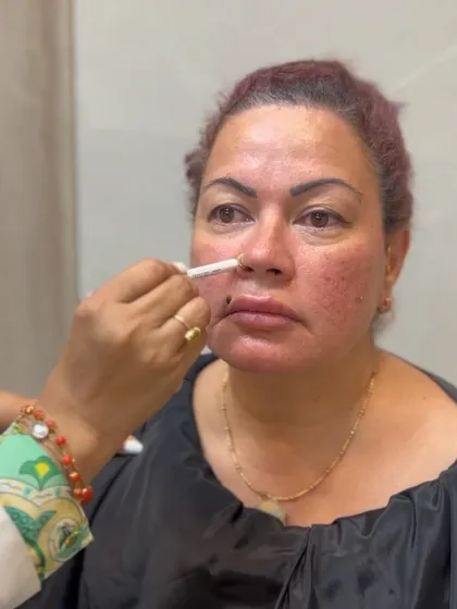 Here, I am marking the treatment area for a threadlift designed to address nasolabial lines, the lines that run from the nose to the corners of the mouth. Proper planning is crucial for targeting specific areas of concern.
