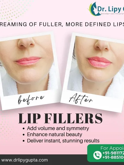 Lip fillers are not about creating an unnatural pout. Here, I focused on enhancing this patient's natural lip shape, adding subtle volume and definition for a beautifully balanced and hydrated result.