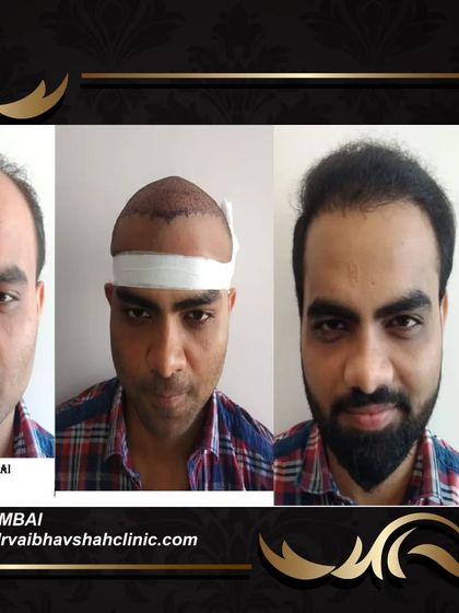 A frontal view of the same patient's journey. Seeing the intermediate step helps set realistic expectations for the recovery and growth timeline.