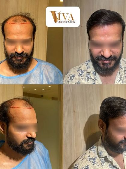 A closer look at the transformation. Seeing my patients happy with their natural, fuller hair is the ultimate reward for the detailed work we put in.