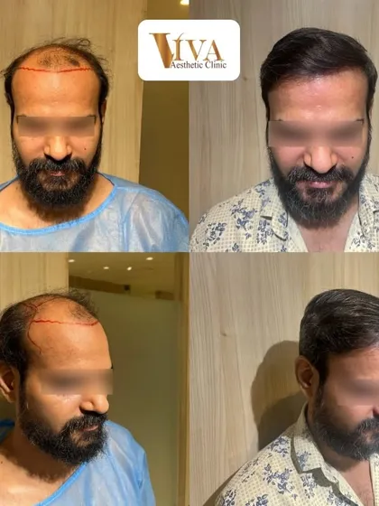 A closer look at the transformation. Seeing my patients happy with their natural, fuller hair is the ultimate reward for the detailed work we put in.