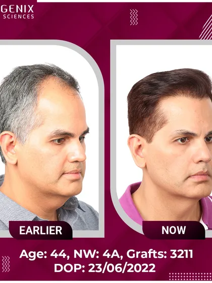 Real results for real people: a 44-year-old's successful 3211-graft transplant.