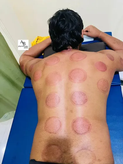 The after-effects of a cupping session. The marks indicate areas of blood stagnation and will fade within a few days, leaving the muscles feeling looser and more relaxed.