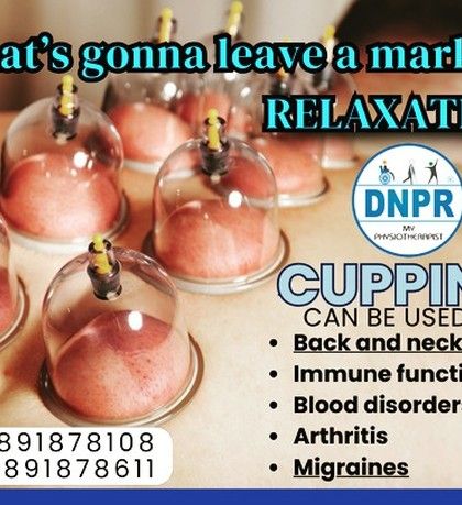Those marks are not bruises; they are marks of relaxation. Cupping is a versatile therapy that can be used for everything from back and neck pain to improving immune function and reducing migraines.