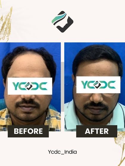 This front-view before and after shows the significant impact of a well-executed hair transplant. The patient now has a fuller head of hair and a restored hairline.