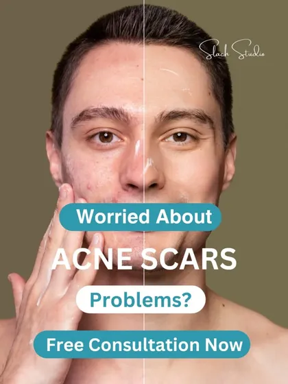 Worried about acne scars? I offer solutions that can help smooth your skin's texture and restore your confidence. A free consultation is the first step.