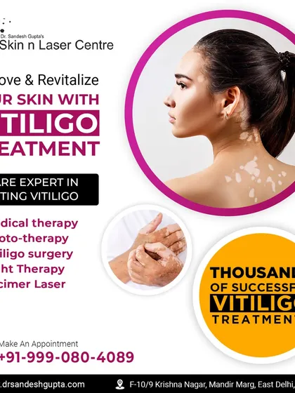 We are experts in treating Vitiligo. This graphic lists our comprehensive treatment options, including medical therapy, phototherapy, and advanced Excimer laser.