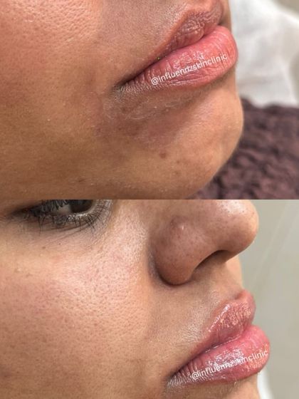This side-view transformation shows how lip fillers can improve the profile and add a touch of youthful volume.