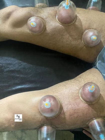 We use static cupping on the legs to treat post-workout stiffness and soreness in the quadriceps and surrounding muscles.